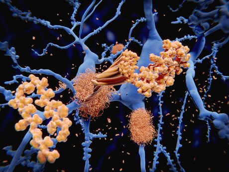Copper Compound Clears 42% of Alzheimer's Toxic Proteins