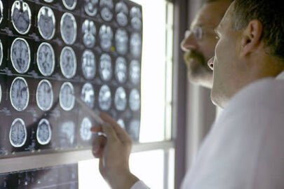 A Rare Gene Variant May Shield High-Risk APOE4 Carriers